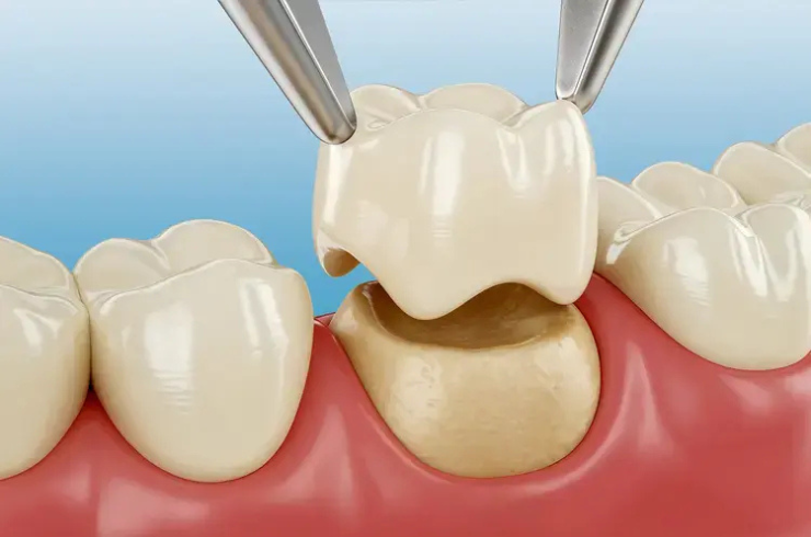 Dental Crowns