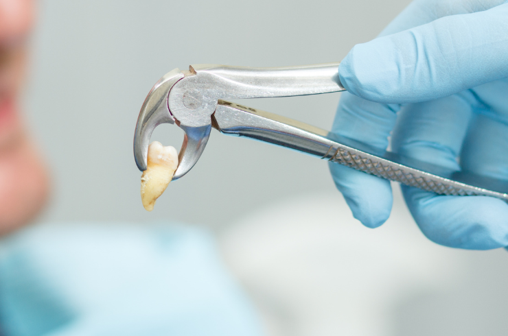 Tooth Extraction